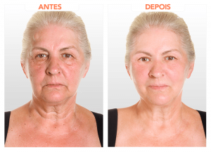 Hialuroni Caps anvisa